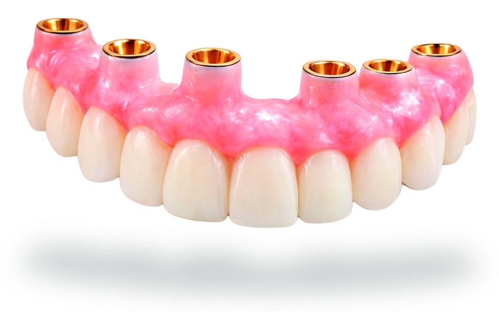 Prótesis fija sobre implantes con pilares Multi-Unit