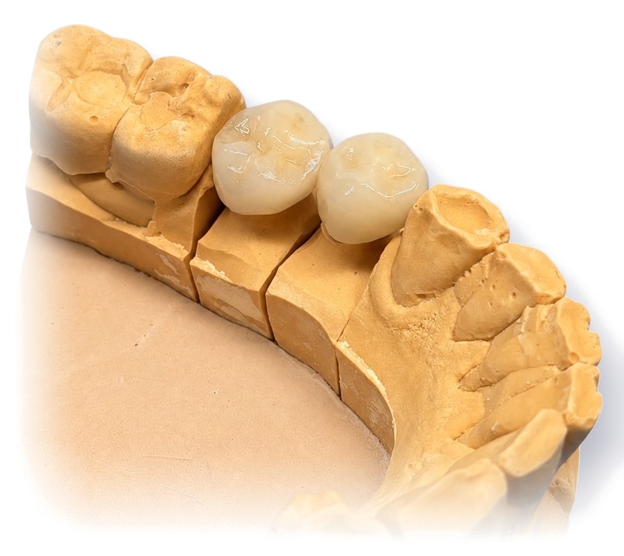 Coronas de zirconio sobre modelo de trabajo
