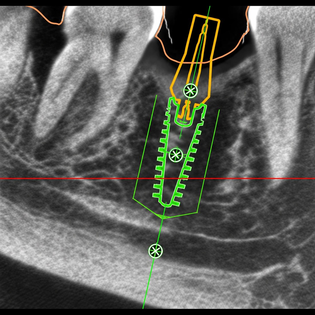 Planificaci&oacute;n 3D del implante sobre el CBCT