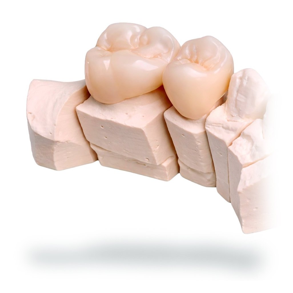 Corona de zirconio cementada