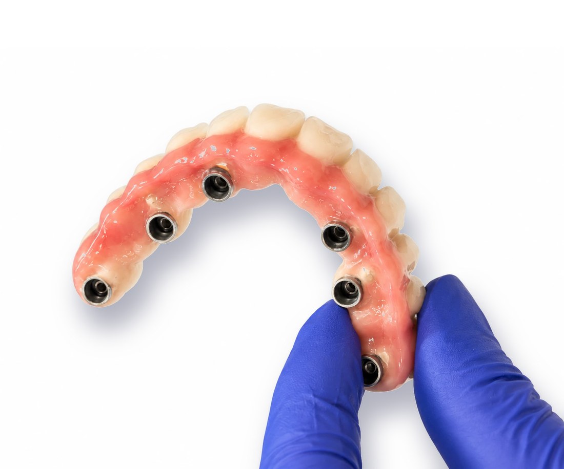 Arcada sobre implantes sujeta con guante