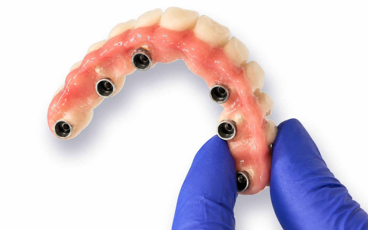 Prótesis fija sobre implantes sujeta con guante
