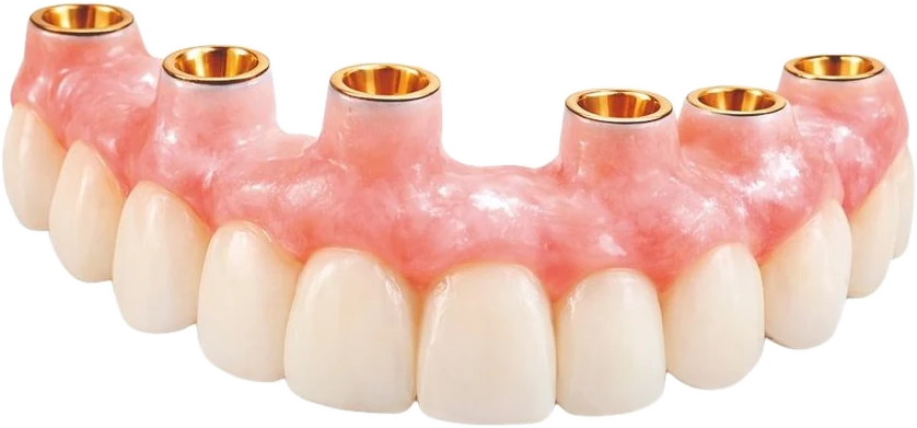 Protesis hibrida sobre implantes con cilindros